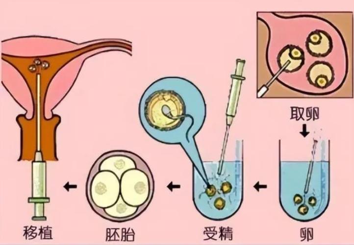 供卵供精试管婴儿【供卵供精试管婴儿:新生命的奇迹】